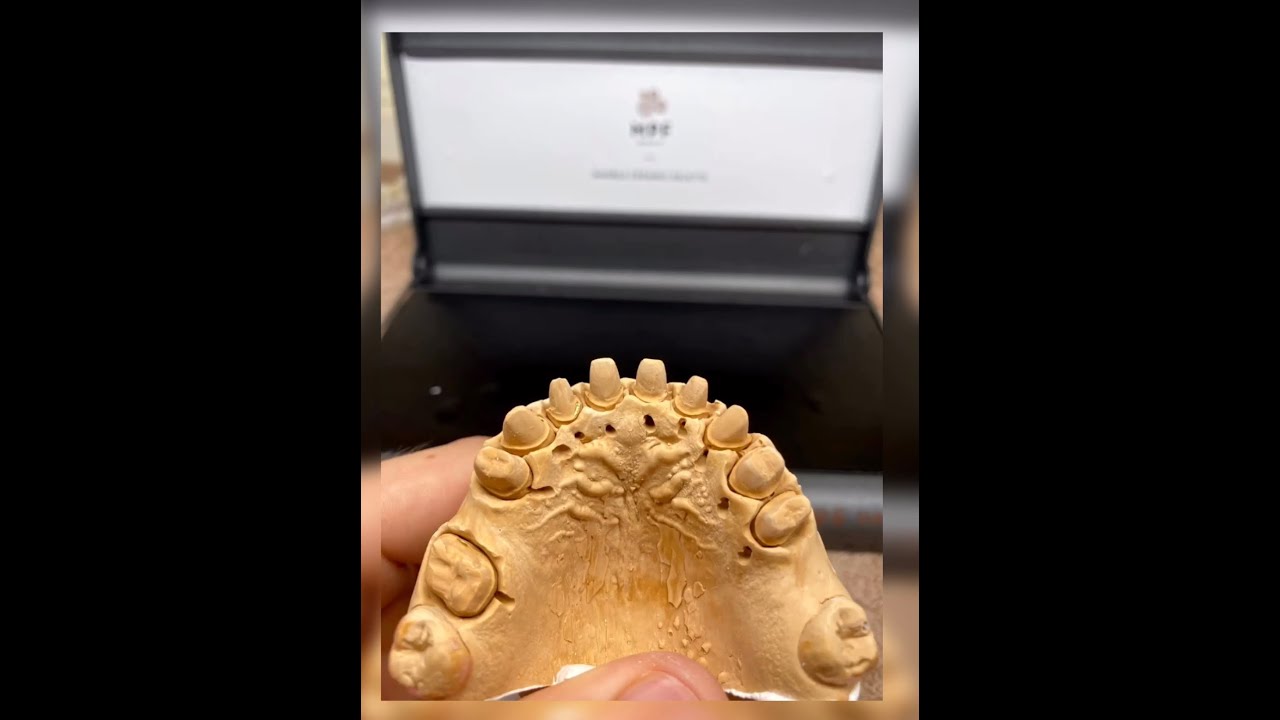 Feldspathic Crowns on refractory керамика зубной техник Техника нанесения dental technician technik