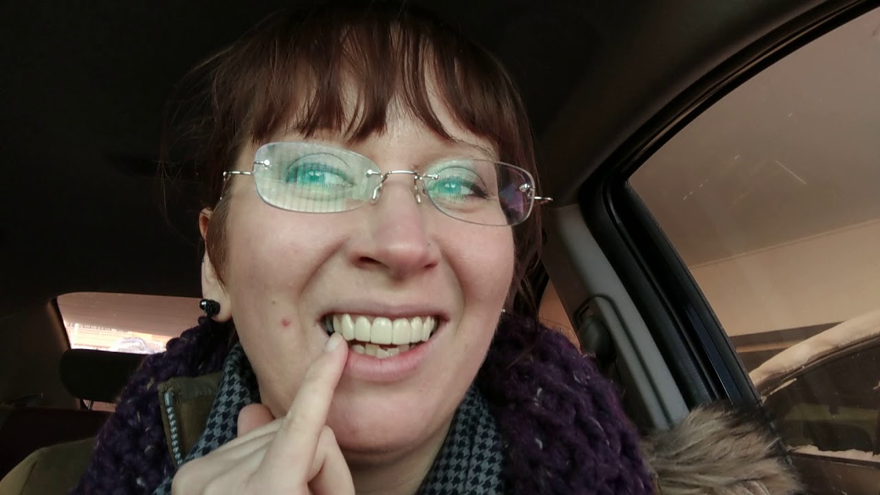 My dental bridge journey - part 9 - final cement