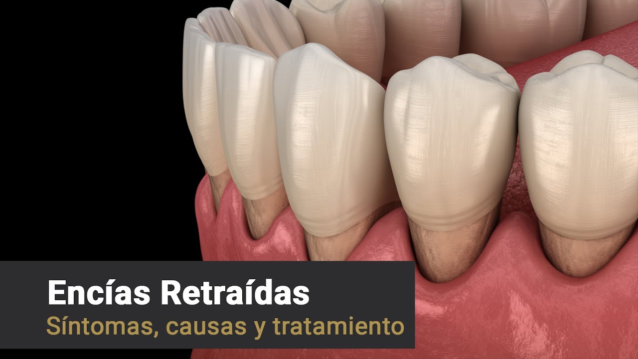 Provenza Clínica Dental - Encías Retraídas; Síntomas, Causas y Tratamiento