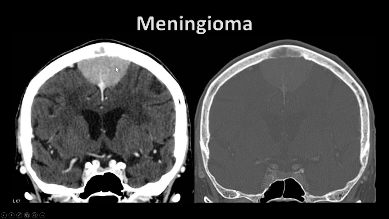 Meningioma