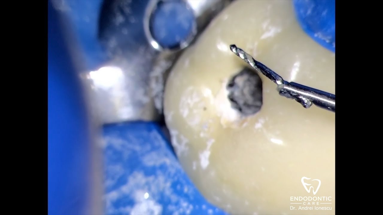 Broken file removal using the IRS system. Dr. Andrei Ionescu