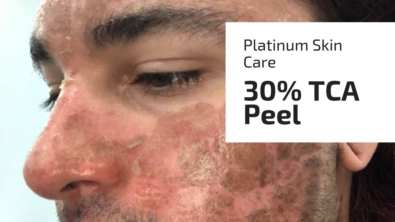 Platinum Skin Care 30% демо TCA (веганский)