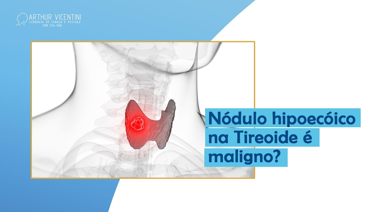 Nódulo hipoecóico na Tireoide é maligno? | Dr. Arthur Vicentini CRM 154.086