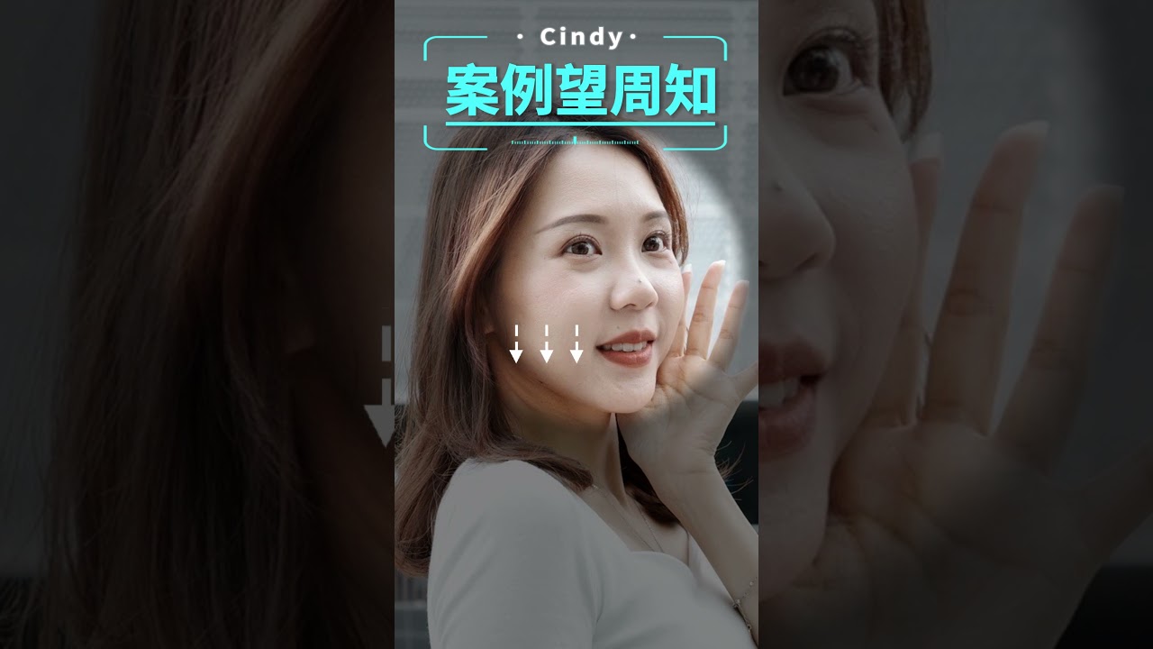 顴骨低卻又baby face、讓眼袋好明顯？➤ 移除眼袋+脂肪填補的手術分析