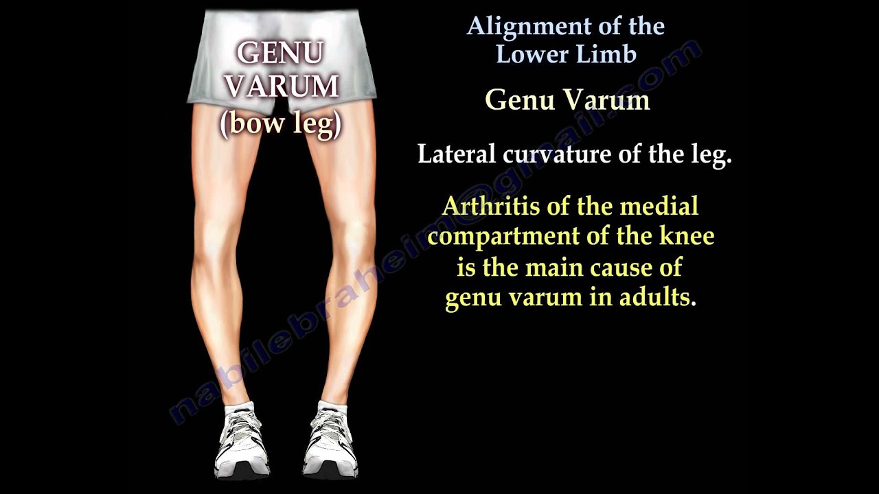 Alignment Of The Lower Limb - Everything You Need To Know - Dr. Nabil Ebraheim