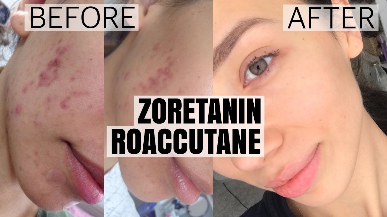 Sivilcelerimden Nasıl Kurtuldum ? | ZORETANIN TEDAVİM | YAN ETKİLER | SOHBET | ROACCUTANE - ACNE