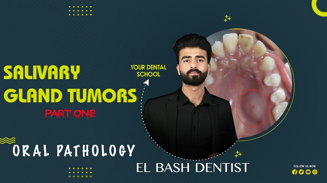 benign salivary gland tumors || oral pathology || عزت شومان