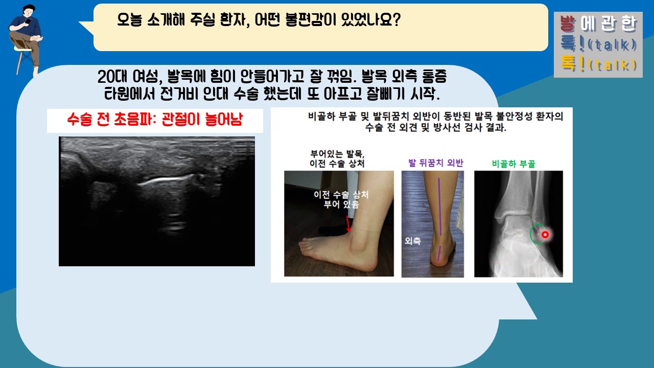 {발톡!}, 발목 불안정성의 수술적 치료: 비골하 부골 제거 및 종골 절골 수술