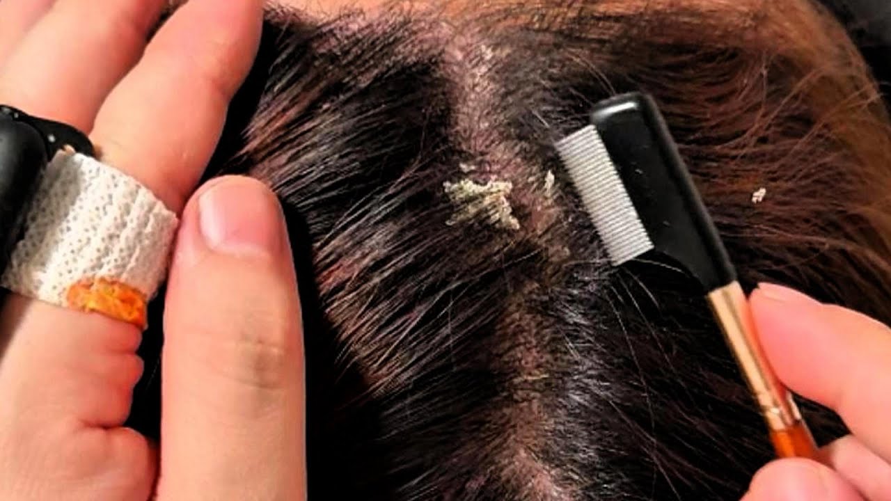 JOJO’s ASMR Scalp Care — Gentle Tweezer Details & Steel Comb Rhythm | No Talking