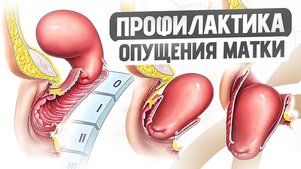 Как перестать ПУКАТЬ влагалищем и справиться с НЕДЕРЖАНИЕМ мочи? Советы опытного гинеколога