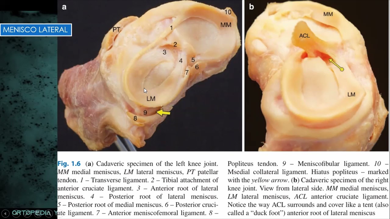 Lesiones Meniscales de Rodilla