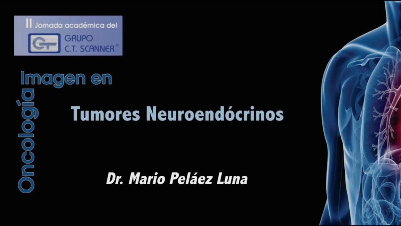 Tumores Neuroendócrinos