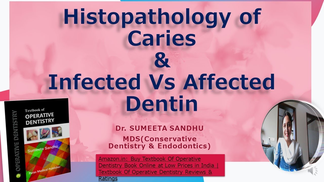 Dental caries| Histopathology of Dental Caries|Enamel caries |Dentinal caries