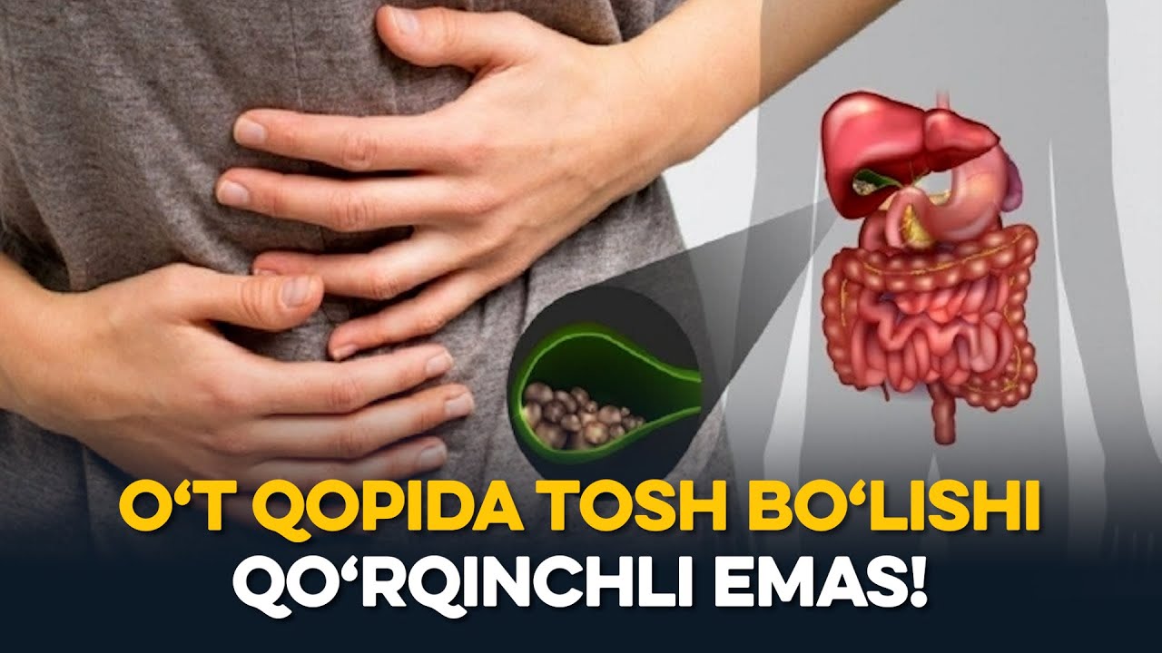 Oʻt qopida tosh paydo boʻlsa uni olib tashlagan maʼqul – professor maslahatlari