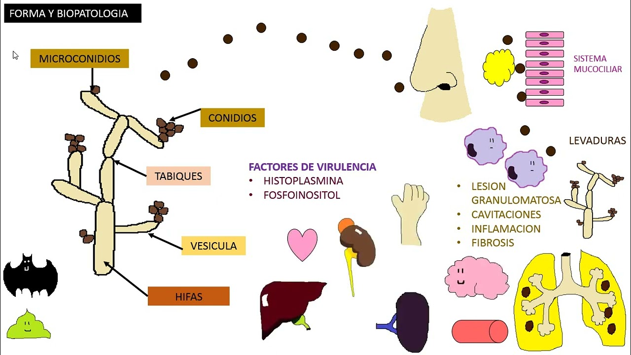 HISTOPLASMOSIS , Histoplasma Capsulatum
