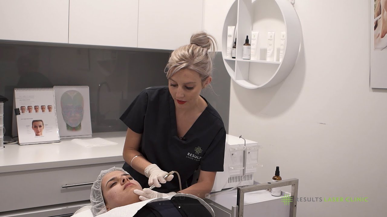 What are Microdermabrasion's good for? - Results Laser Clinic