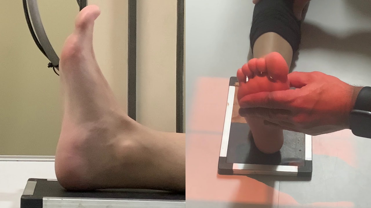 RX TOBILLO FRENTE, PERFIL  Y AXIAL DE CALCÁNEO  EN PACIENTE   AMBULATORIO EN EQUIPO CONVENCIONAL.