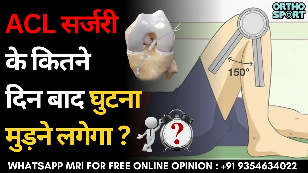 ACL सर्जरी के कितने दिन बाद घुटना मुड़ने लगेगा ? Time to Bend your Knee after #ACL Ligament Surgery