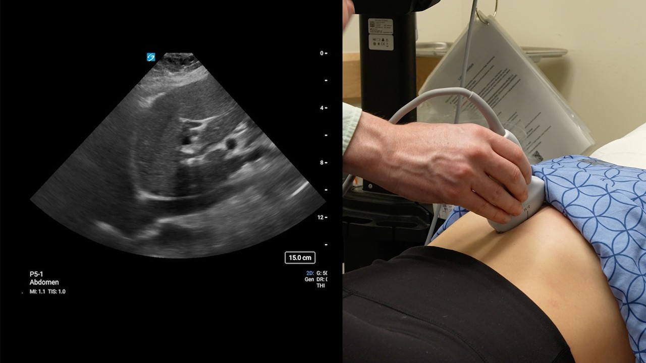 Point-of-Care Ultrasonography of Inferior Vena Cava