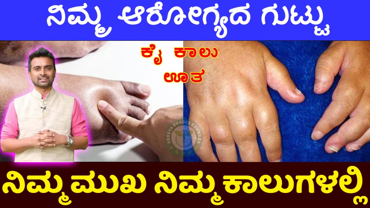 ಕೈ-ಕಾಲು ಊತವನ್ನು ಕಡೆಗಣಿಸಬೇಡಿ । Body Swelling Reasons & Treatment In Kannada | Hand Leg Swelling