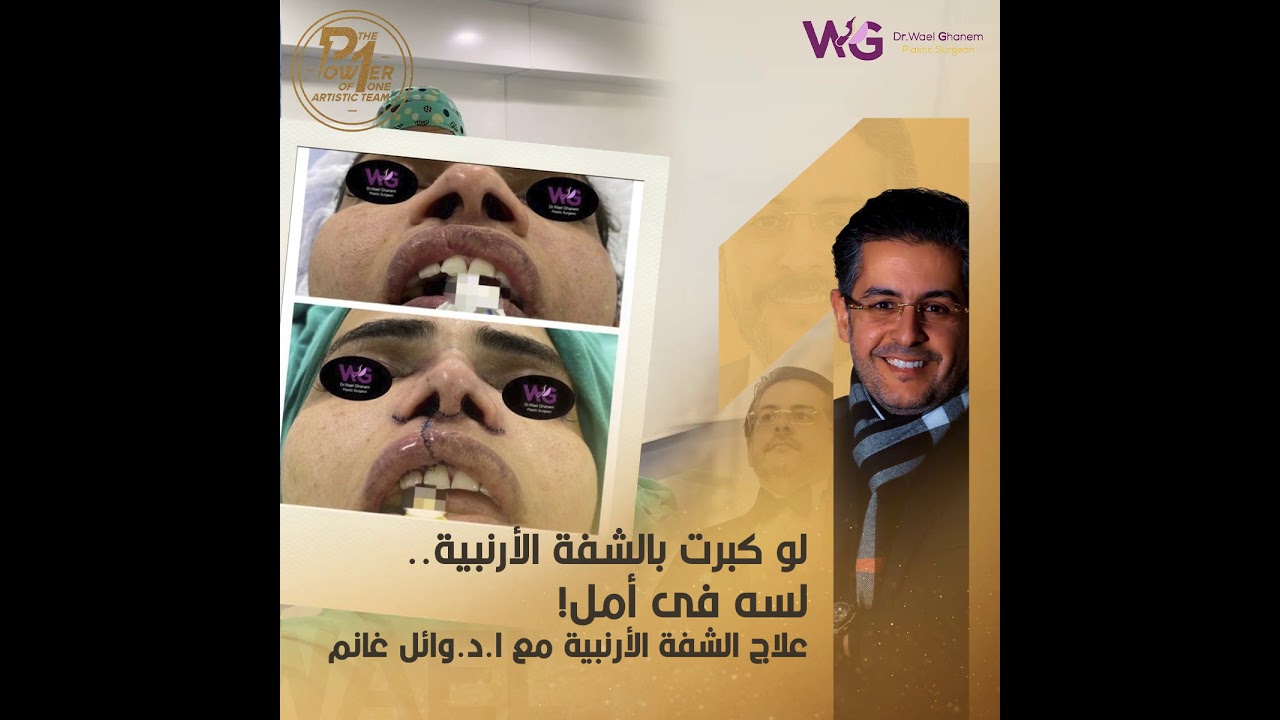 أ.د وائل غانم: هل ممكن إصلاح عملية شفة أرنبية سابقة ؟؟