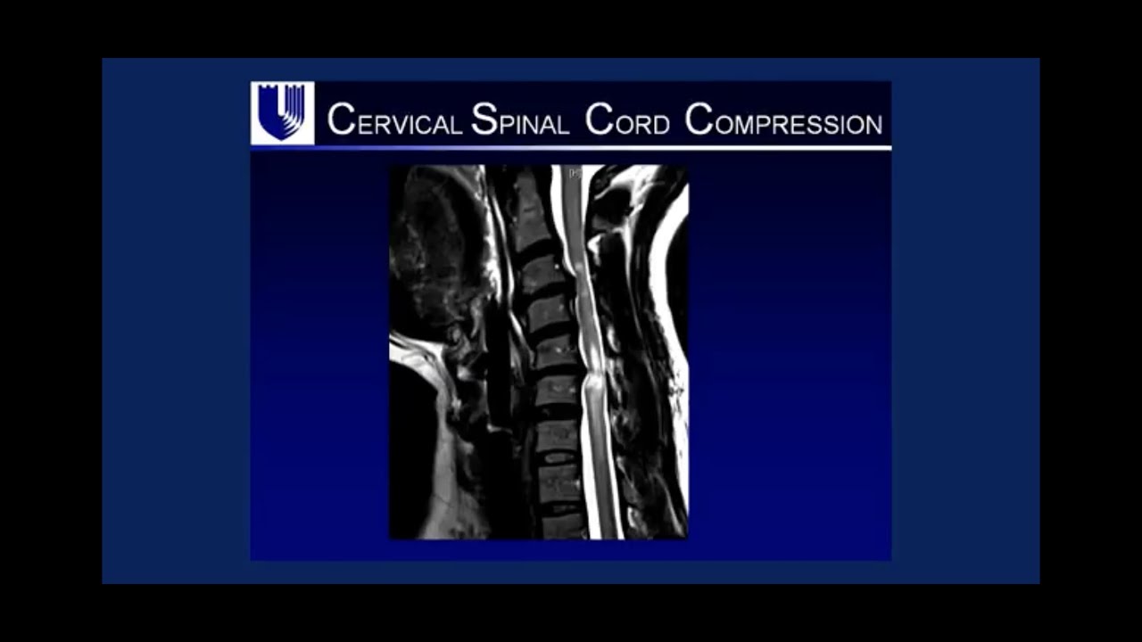MRI spine ,disc prolapse  كيفية قراءة أشعة الرنين المغناطيسي  للعمود الفقري