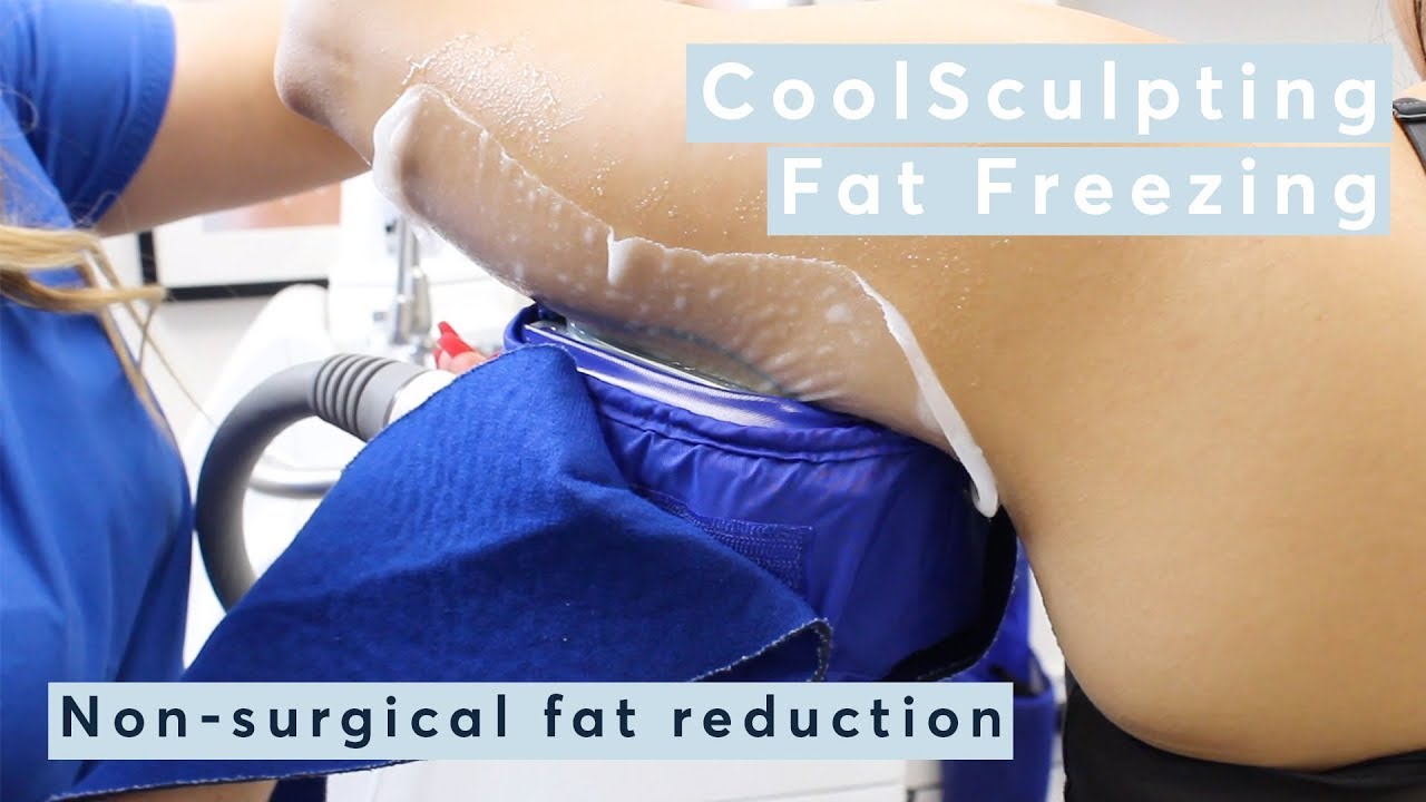 How Does CoolSculpting | Fat Freezing Work?