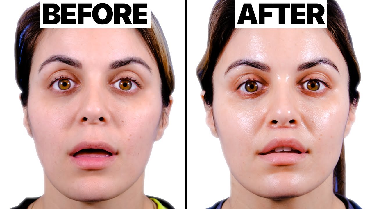 My Lip Lift Journey