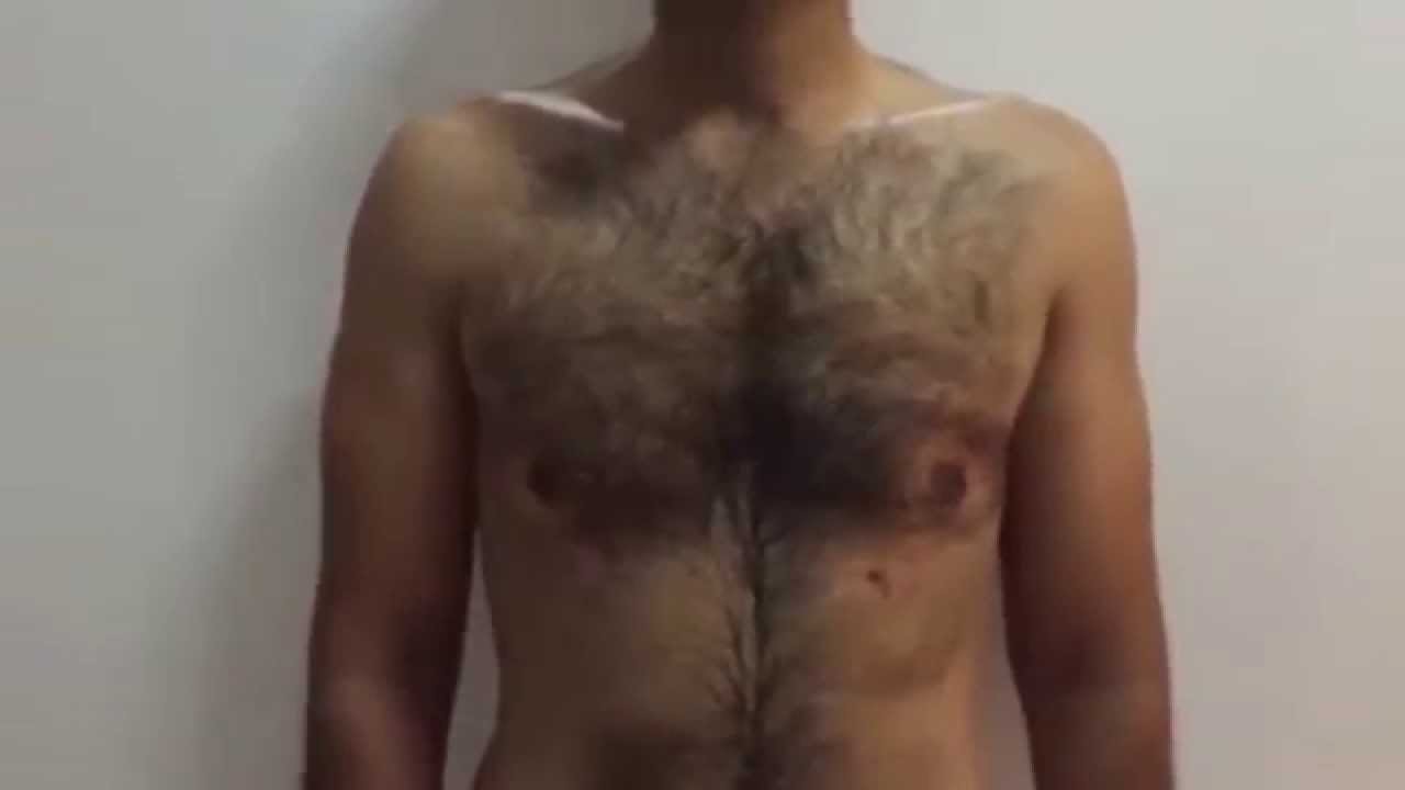 Gynecomastia Treatment by Dr Arif Karachi Pakistan