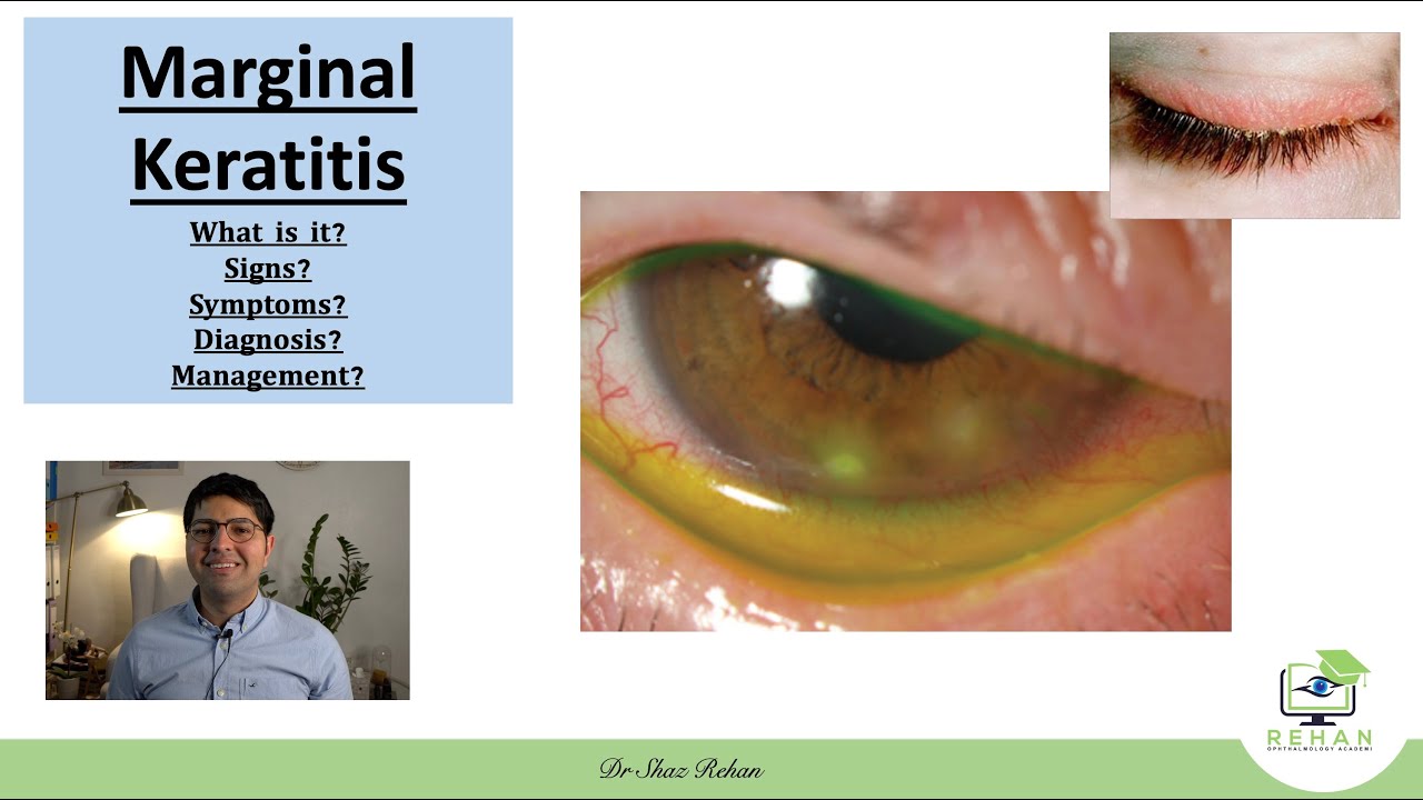 Marginal Keratitis: What is it? How Can it be Prevented? How can it be Treated? I Dr Shaz Rehan, 21