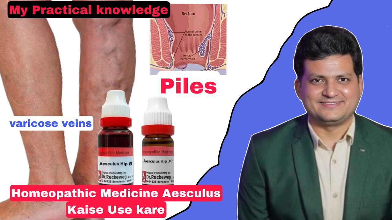 Aesculus Homeopathic Medicine को कैसे Use करें ? For Piles & Varicose veins | My experience