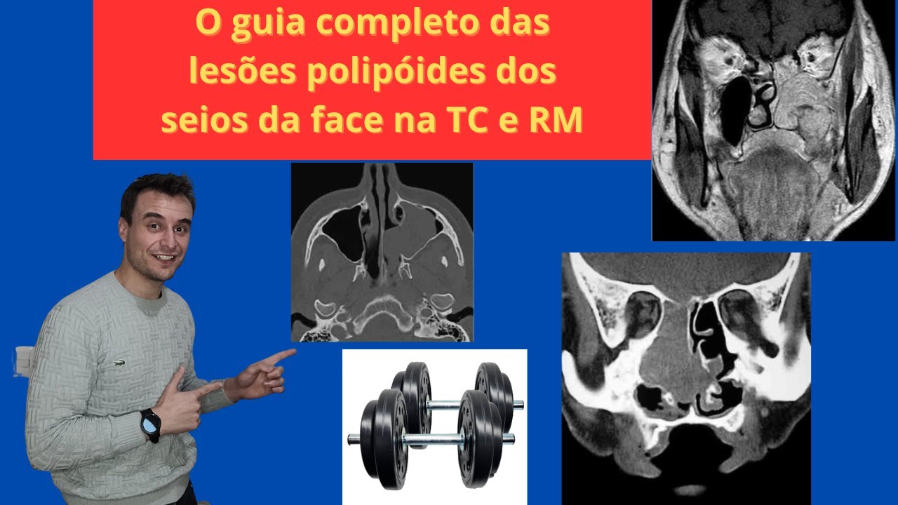 Pólipo nasal, polipose nasossinusal, papiloma invertido, como identificar  tomografia e ressonância