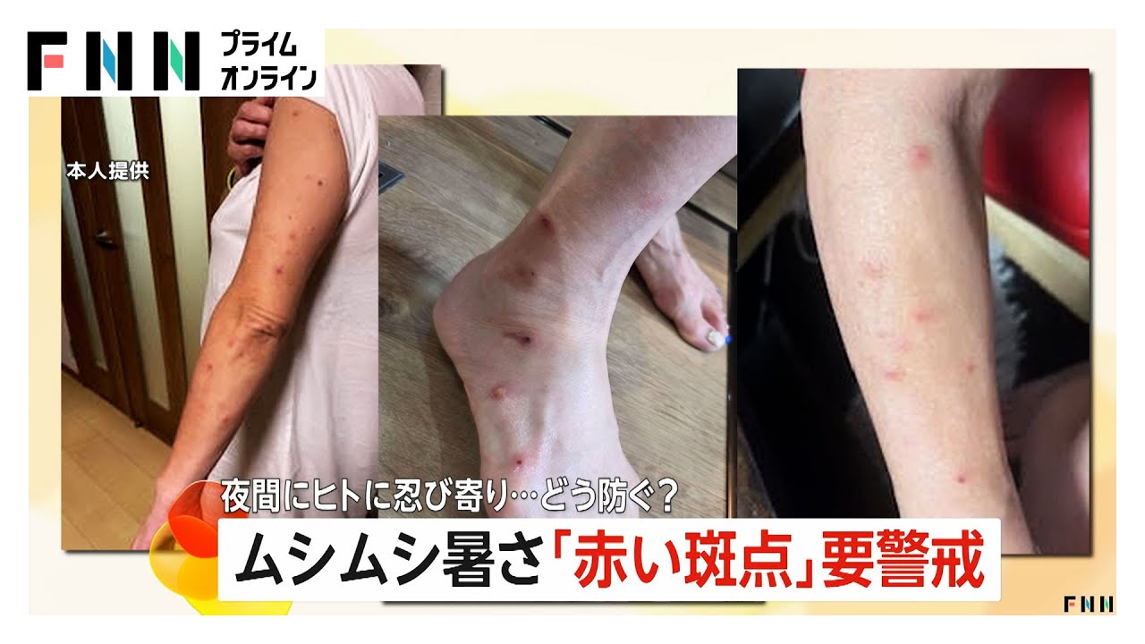 腕や体に100カ所超の“赤い斑点”…夜間に人に忍び寄る「トコジラミ」　眠れないほどの“かゆみ”襲われ…