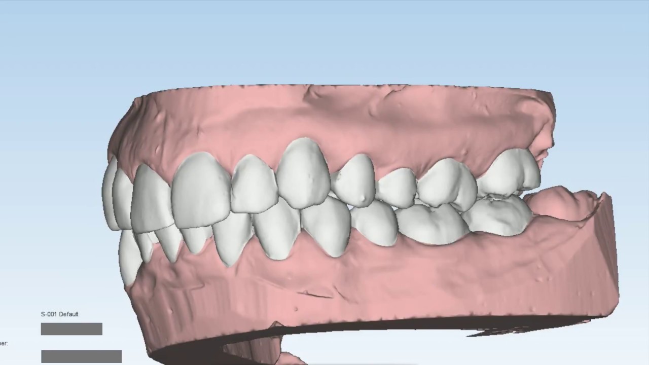 Budapest Dental Láthatatlan fogszabályozás kusza fogak