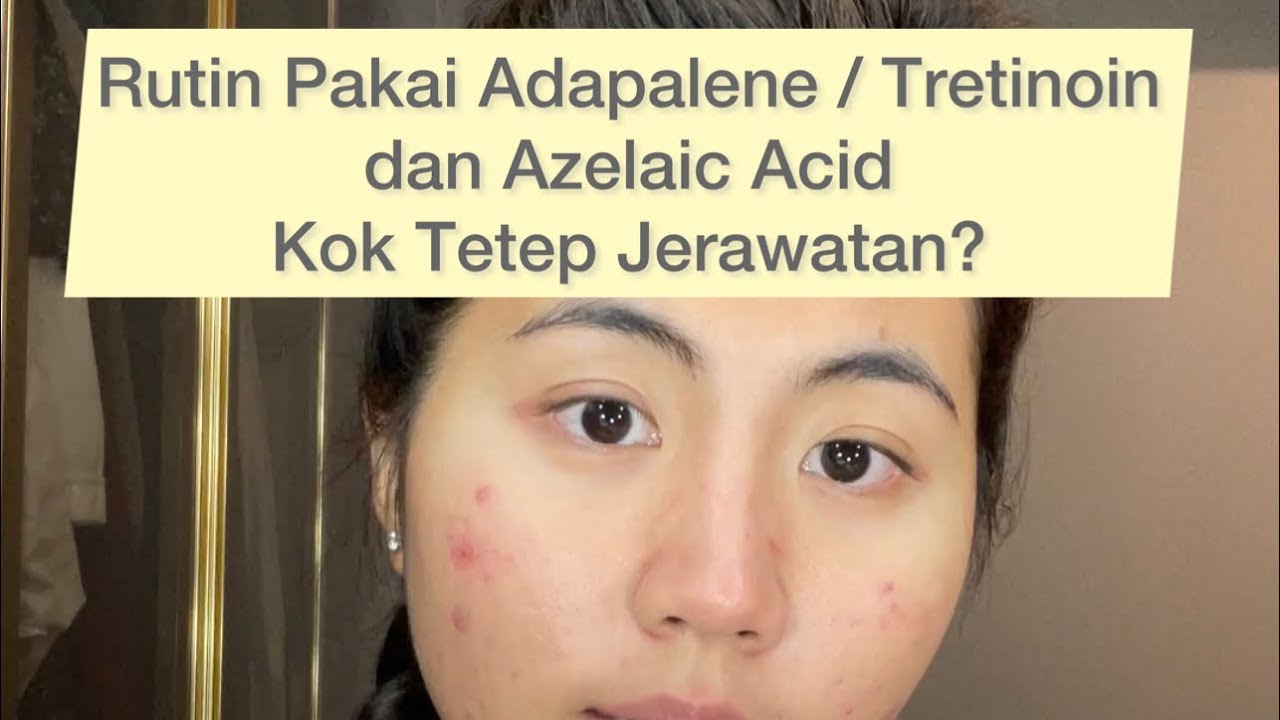 Rutin Pakai Adapalene / Tretinoin & Azelaic Acid Kok Tetap Jerawatan??