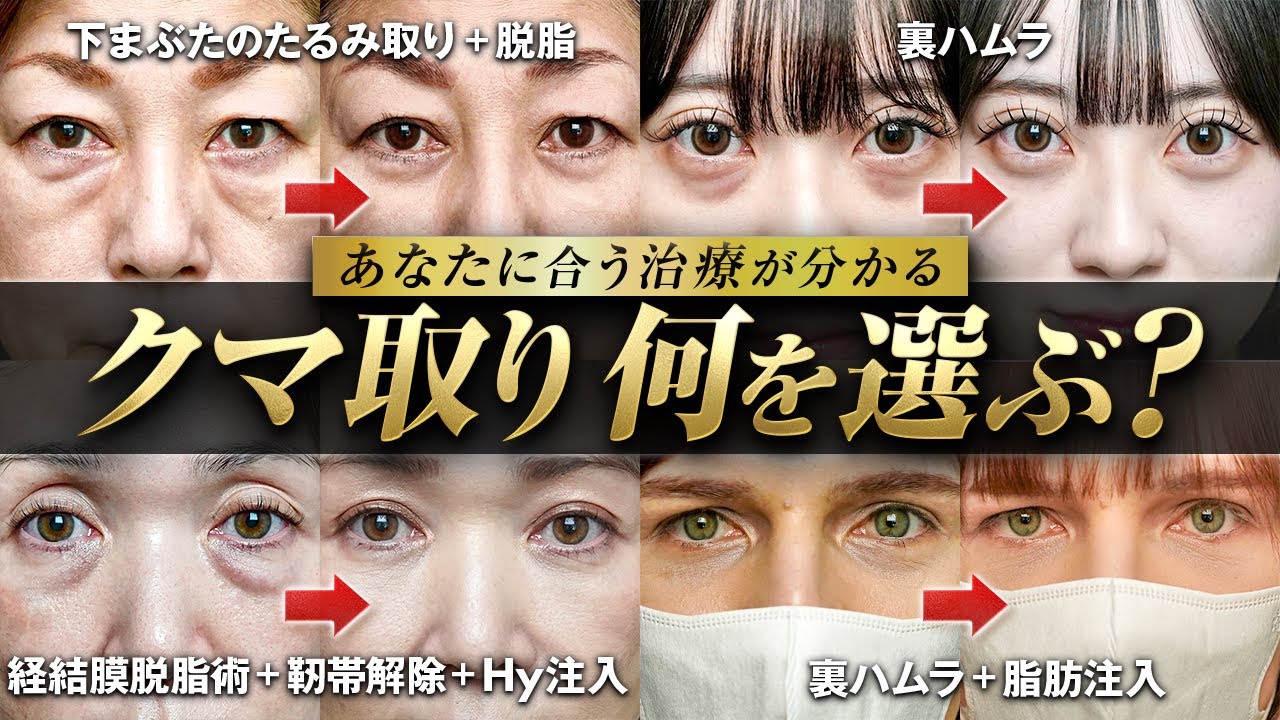 【クマ治療】脱脂・裏ハムラ論争の前に|あなたに最適なクマ治療の選び方