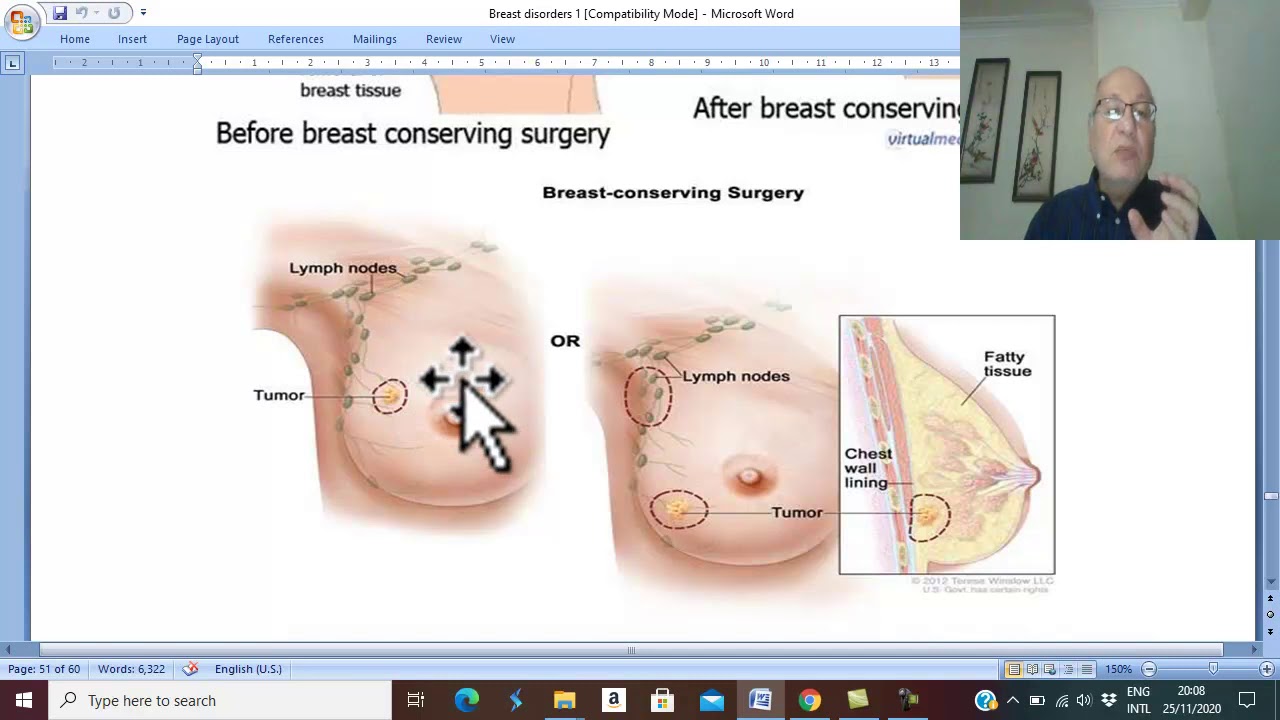 Breast Disorders in Arabic 12 ( Breast cancer ,Treatment 1 ) , by Dr. Wahdan .