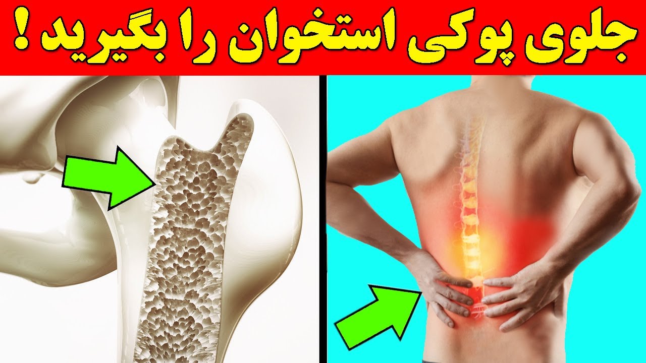 جلوی پوکی استخوان را با این ده روش آسان هر چه زودتر بگیرید !!
