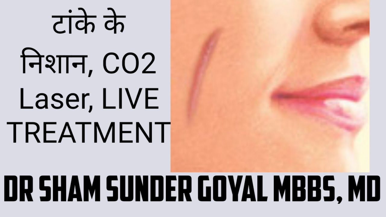 टांके के निशान | CO2 Laser | Live | Hindi | Dr Sham Sunder Goyal MBBD MD | Kayakalp Muktsar Punjab