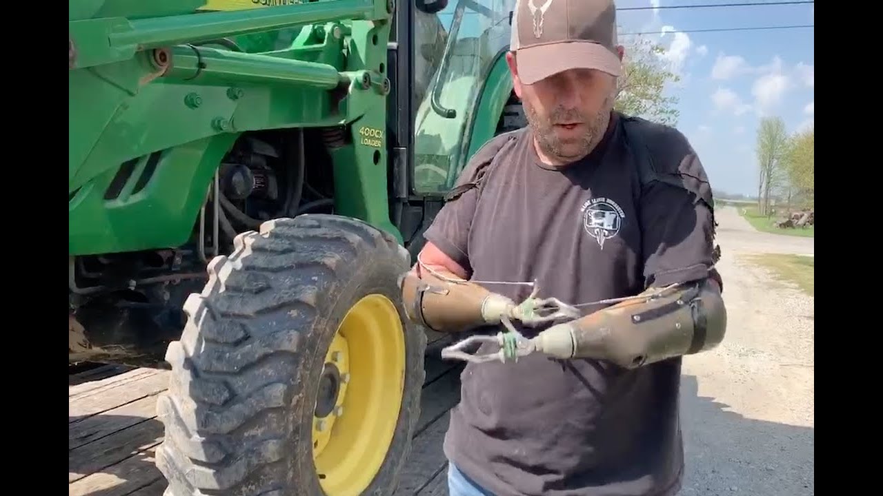A Tractor, a Trailer and Two Body-Powered Prosthetic Arms