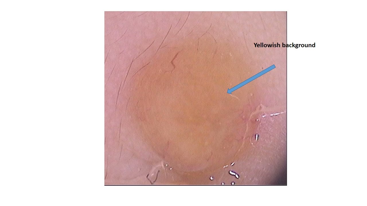 Xanthogranuloma and mimickers - Dr. R. Bakos