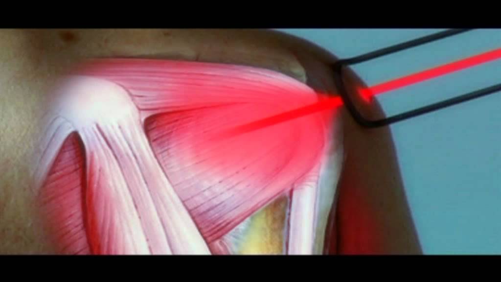 Hilterapia: the therapy