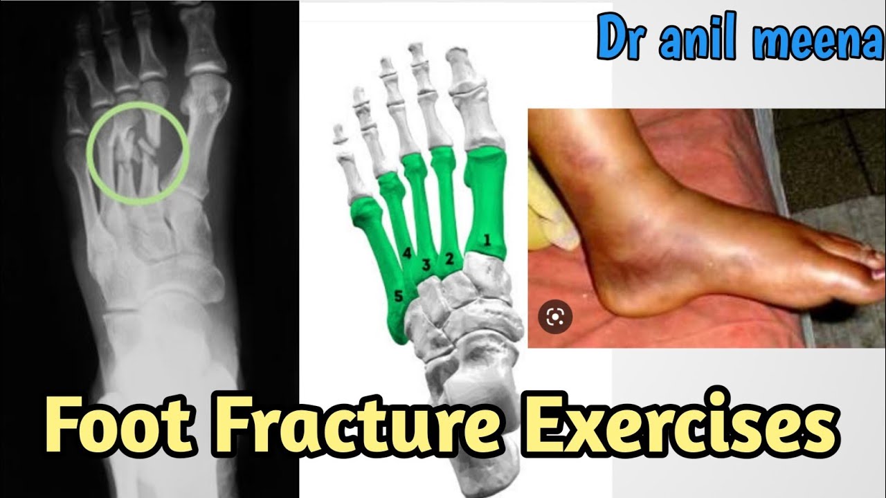 foot fracture recovery exercises | metatarsal fracture recovery exercises | foot metarsal exercise
