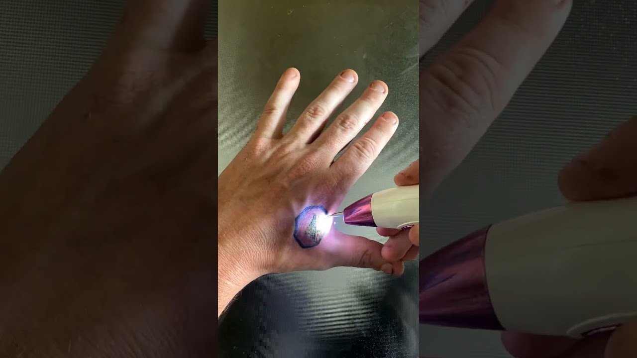 Tattoo removal using a $25 Mole plasma pen