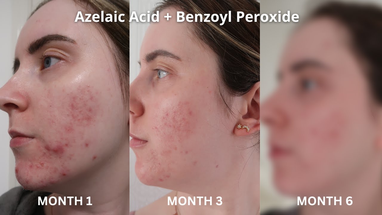 AD 6 Months Of...DERMATICA | Azelaic Acid & Benzoyl Peroxide | Acne, Pigmentation, Scarring