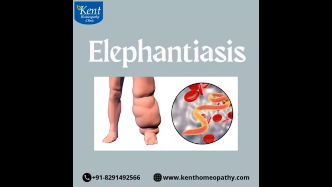 Elephantiasis#elephantiasis#drkukrejakalani#kenthomeopathyclinic#hiranandanipowai#mumbai#kentclinic