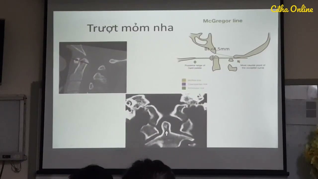 Chẩn đoán hình ảnh Chấn thương Cột sống