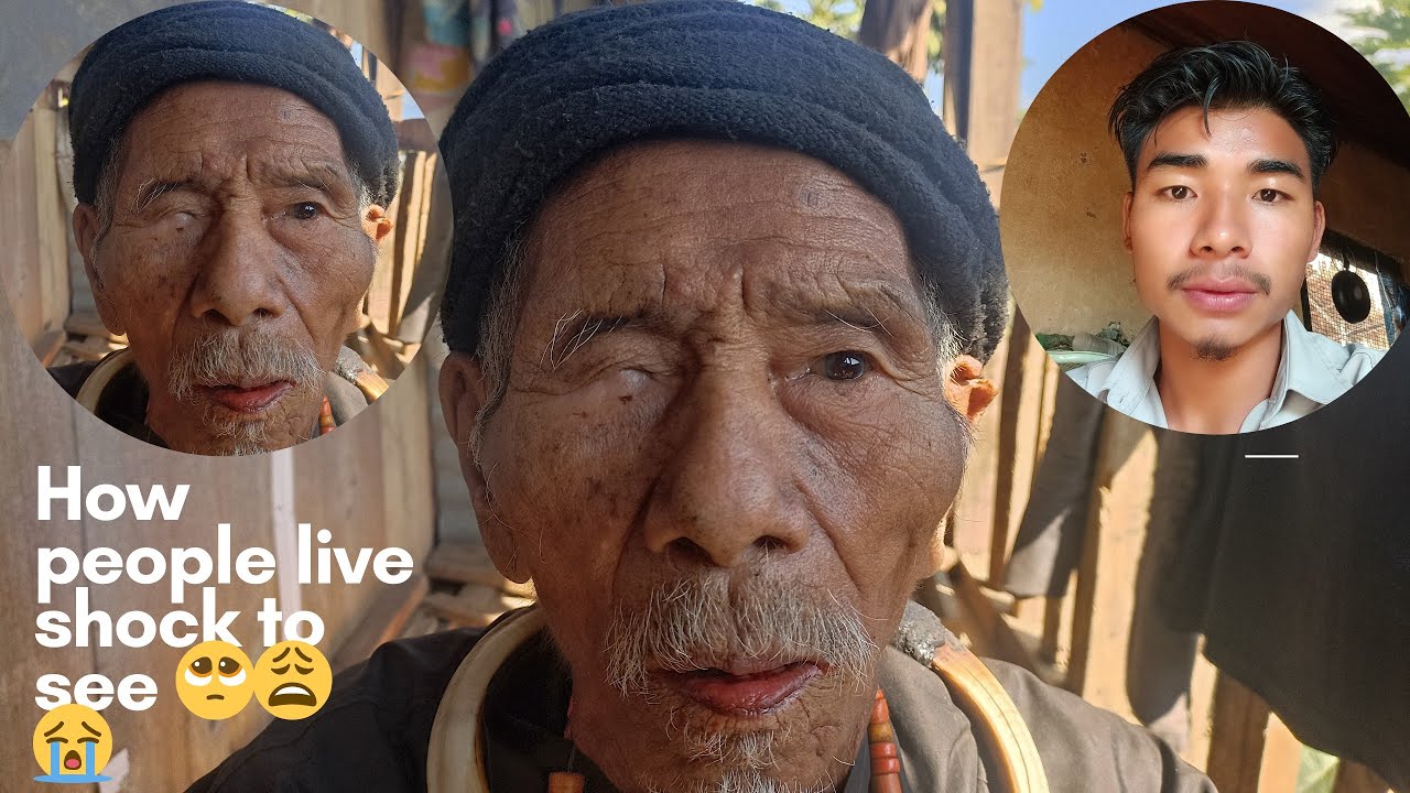 Live more the 100 years with one eye😭🥺😩