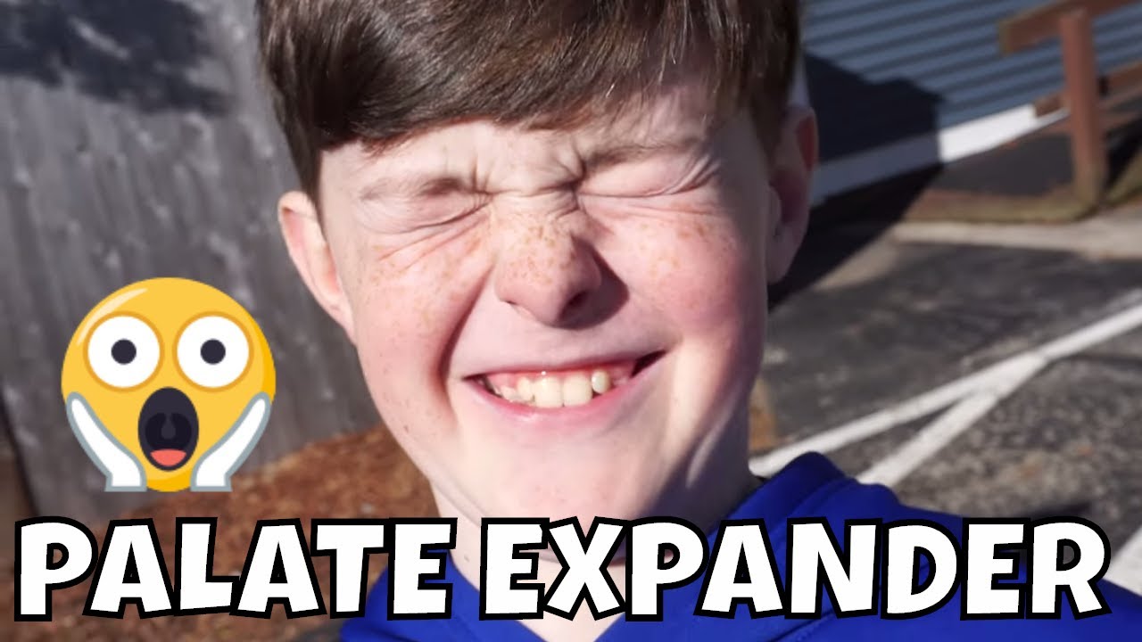 AIDAN GETS A PALATE EXPANDER FOR BRACES 😱