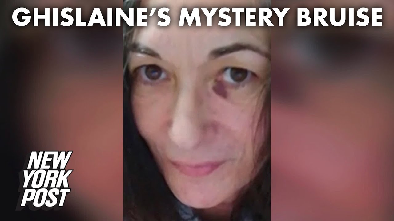 Ghislaine Maxwell pictured for the first time behind bars — with a bruise | New York Post